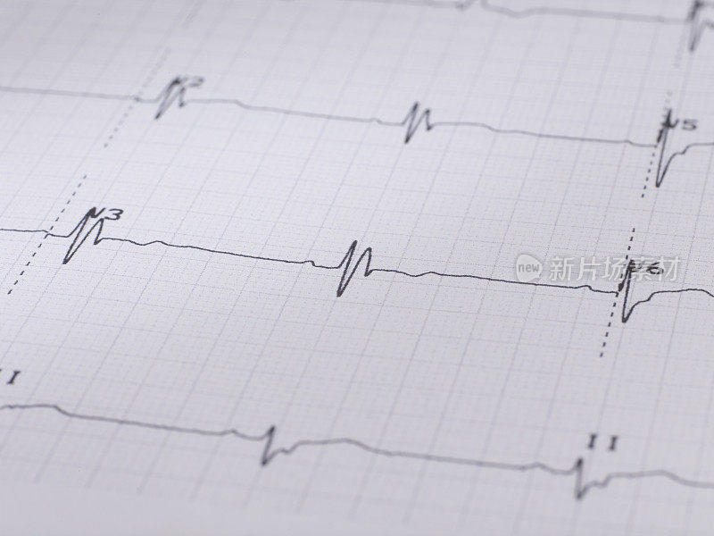 心电图(ECG)