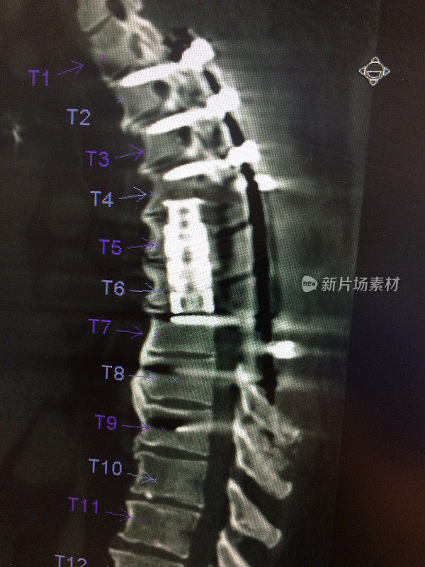 植入物重建后的胸椎CT扫描