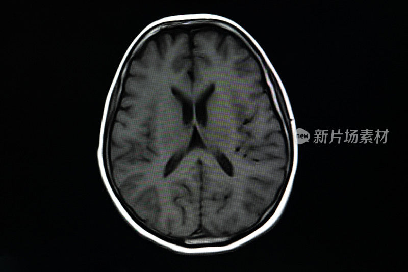 大脑核磁共振扫描。扫描大脑磁共振图像。诊断医疗工具