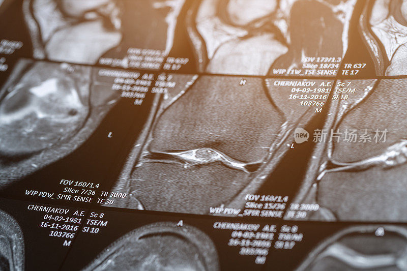 膝关节磁共振(MRI)扫描