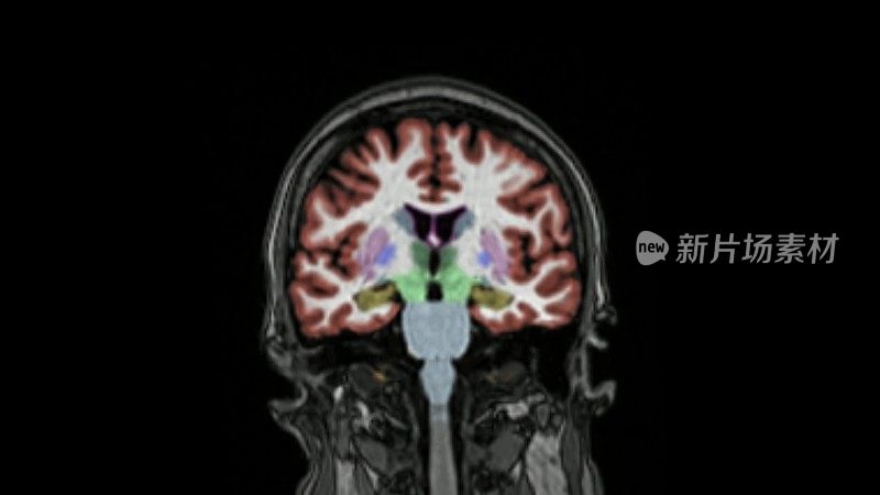 核磁共振成像的大脑。阿尔茨海默病。