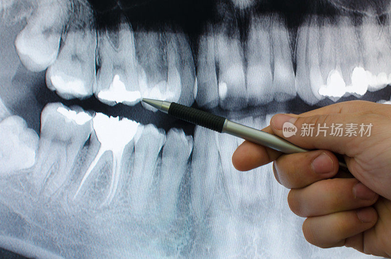 牙科医生在牙科x光图像上显示了一些东西