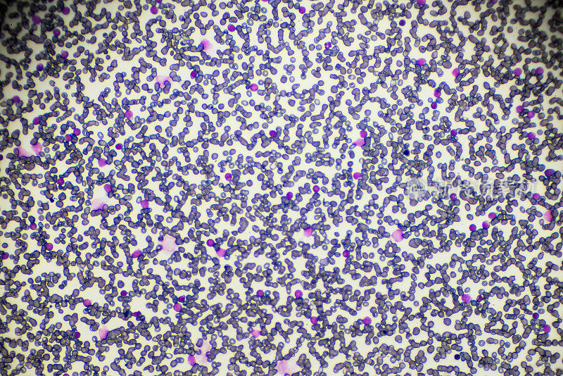 光镜下急性淋巴母细胞白血病ALL-L3血液涂片