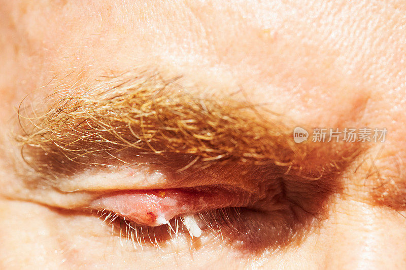 男人眼内讨厌的鼻炎:上眼睑红肿，感染，涂满眼药膏