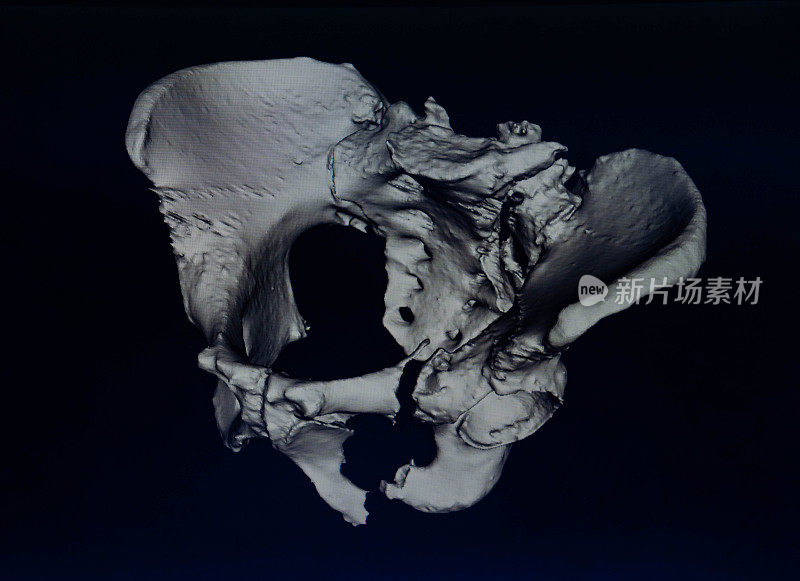 骨盆骨折的CAT扫描建模