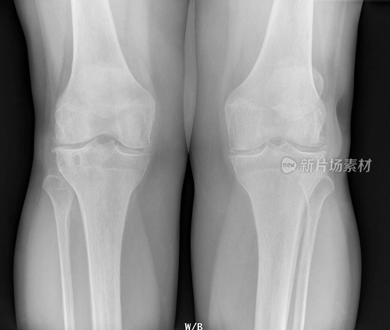 膝关节软骨钙质沉着的数字x光片