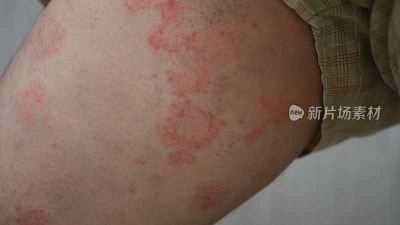 男人大腿上的过敏荨麻疹或卡里格塔。