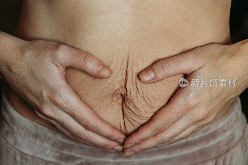 年轻女子怀孕后肚子上满是妊娠纹。