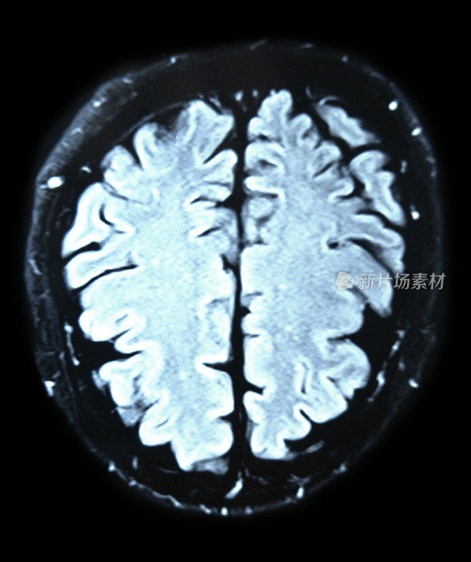 用颅骨对大脑进行磁共振扫描。