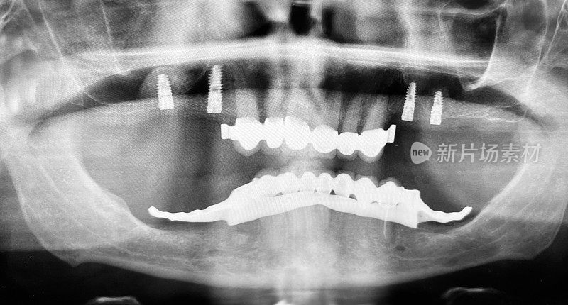 牙科手术后x光片:4颗种植体植入上颌