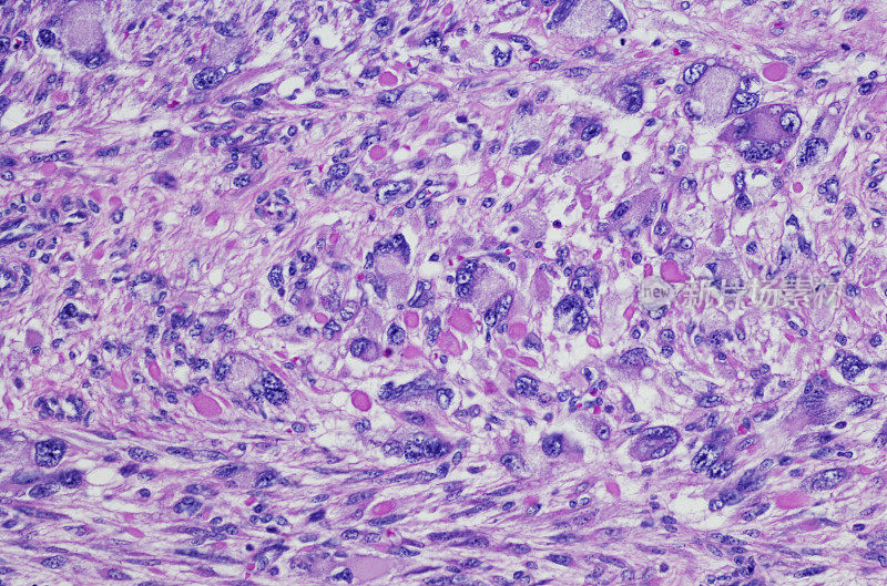子宫平滑肌瘤的奇异核(LM-BN)