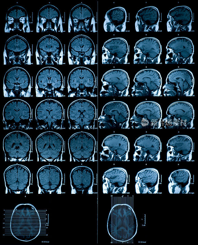 脑MRI扫描