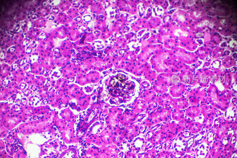 显微镜下急性肾盂肾炎活检标本