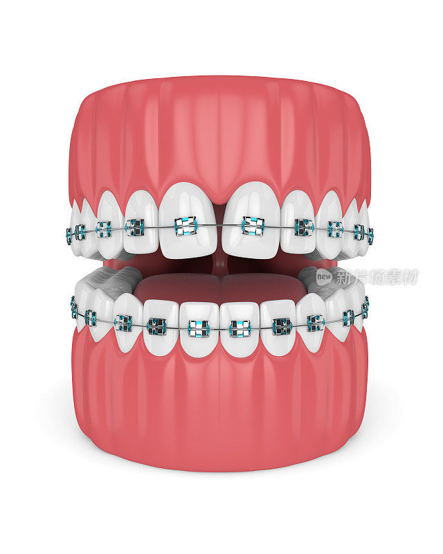牙的三维渲染与收敛的隔膜和牙套