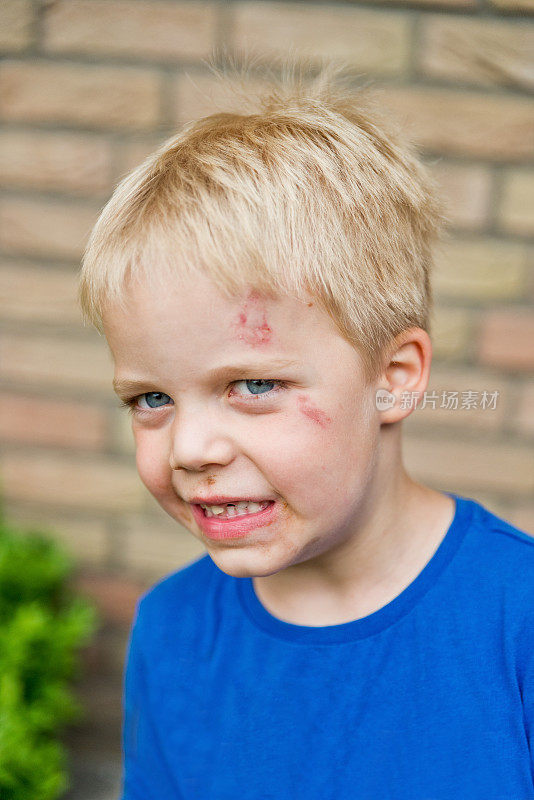 小男孩脸上有擦伤