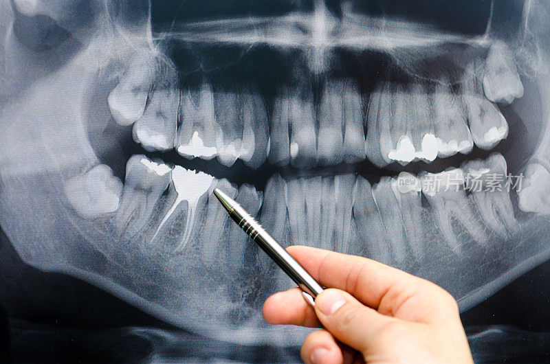 牙科医生在牙科x光图像上显示了一些东西
