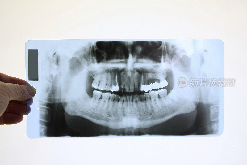 牙医正在检查人类牙齿的x光图像