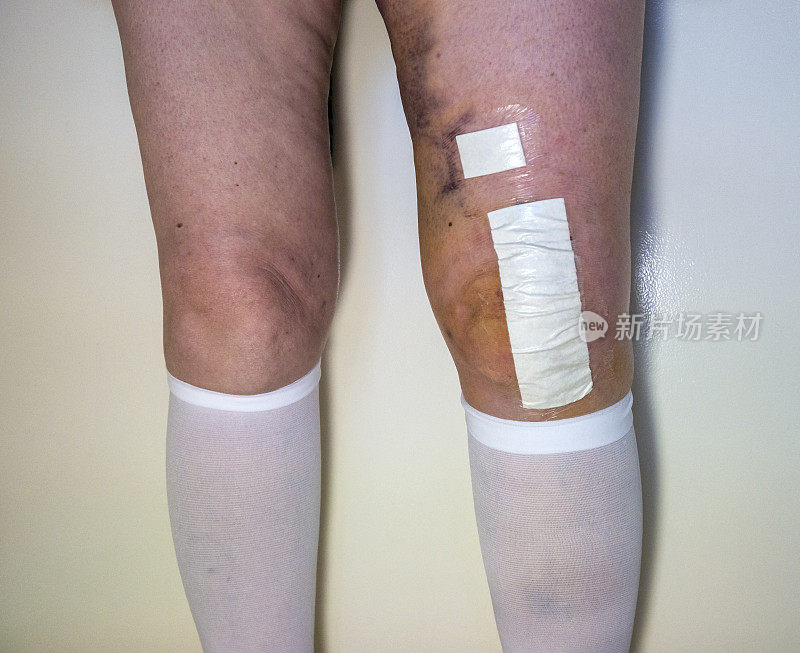 膝盖部分置换手术后，有瘀伤的老年妇女的腿和TED长袜