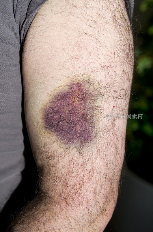 一个男人手臂上的紫色大瘀伤