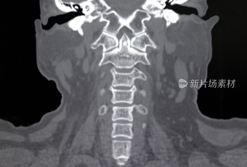 人颈椎CT图像(骨窗)