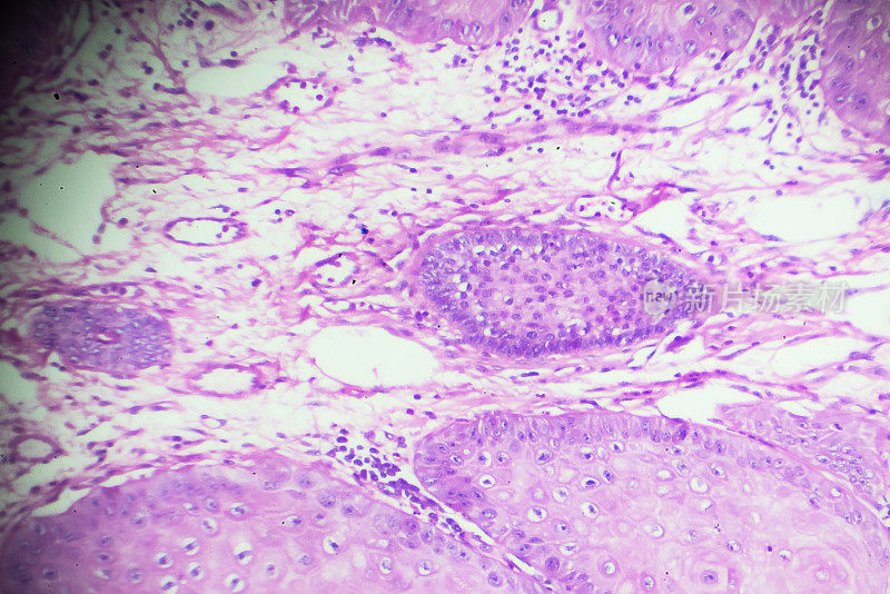 鳞状细胞癌显微镜下