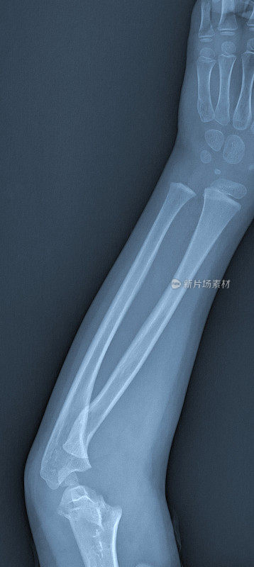 手臂骨折x光