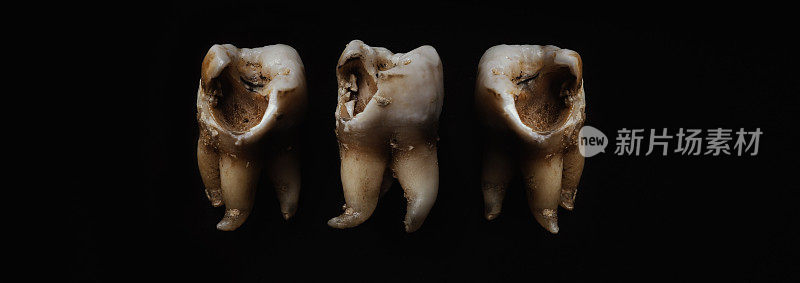 黑色背景上有蛀牙。牙科医生拔牙后的蛀牙至牙根的微距照片。真正的牙齿解剖，由于缺乏护理。黑纸上龋齿纹理的俯视图。牙科保健。
