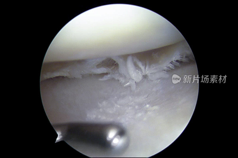 膝关节骨性关节炎和退行性半月板撕裂的关节镜观察