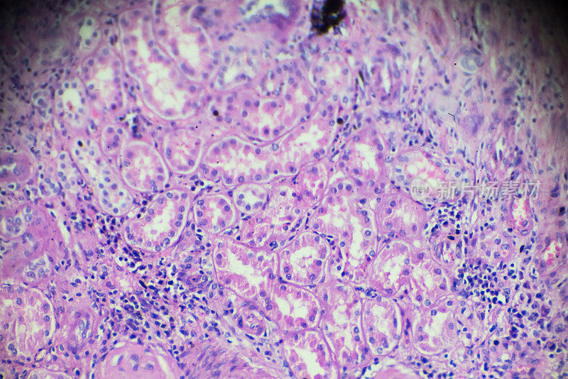 光镜下慢性肾盂肾炎活检