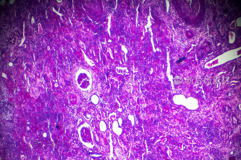 显微镜下硬化性肾小球肾炎活检标本