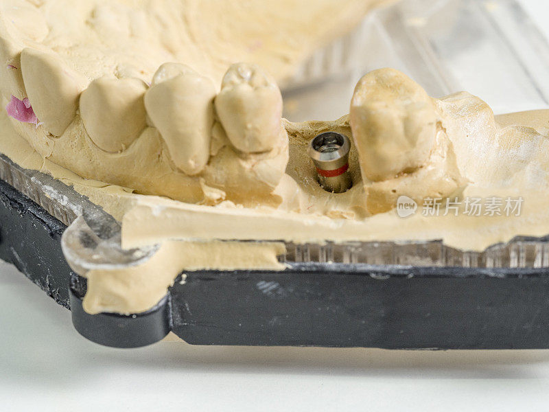 种植复制品在一个铸型牙科
