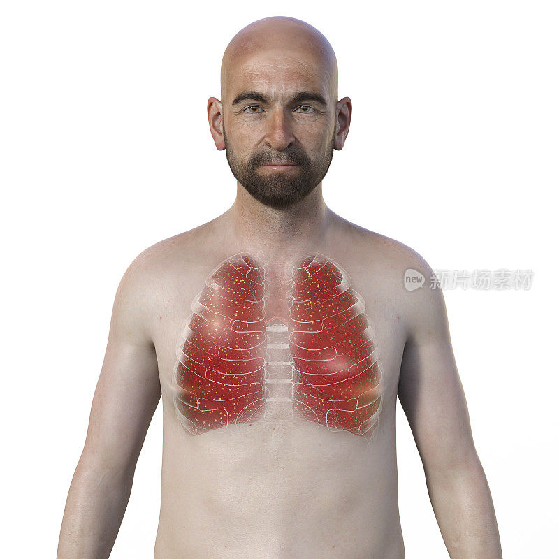 一幅3D插图，展示了一名男子的上半部分，透明的皮肤，显示了受军旅肺结核影响的肺部