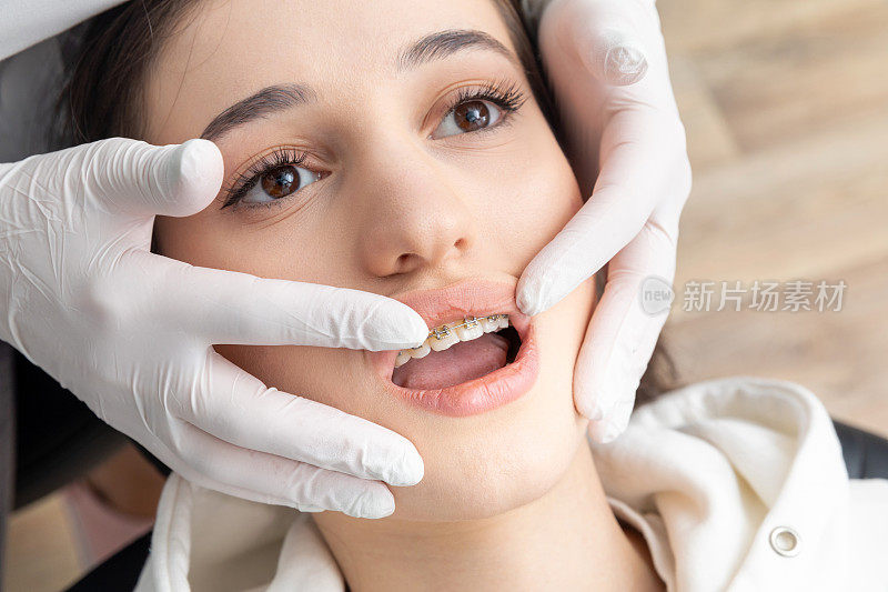 正畸医生检查女性牙齿托槽的特写。口腔科、牙科、牙套正畸治疗的概念