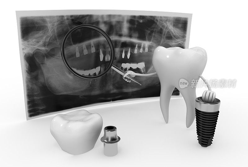 牙齿植入技术