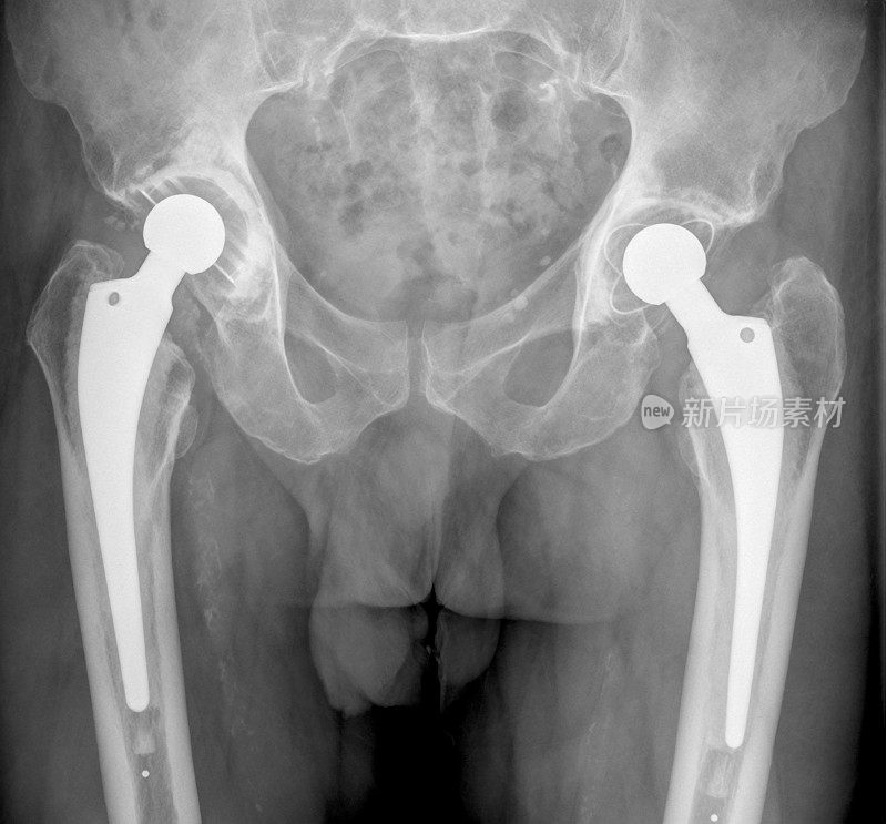 骨盆x光检查双侧全髋关节置换术