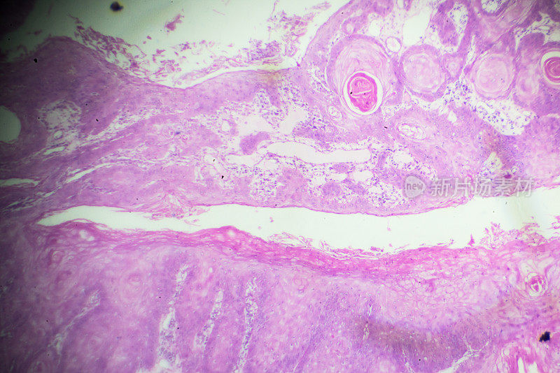 鳞状细胞癌显微镜下