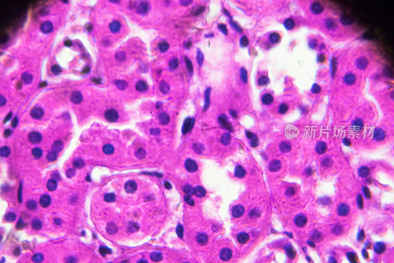 显微镜下急性肾盂肾炎活检标本