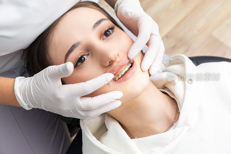 正畸医生检查女性牙齿托槽的特写。口腔科、牙科、牙套正畸治疗的概念