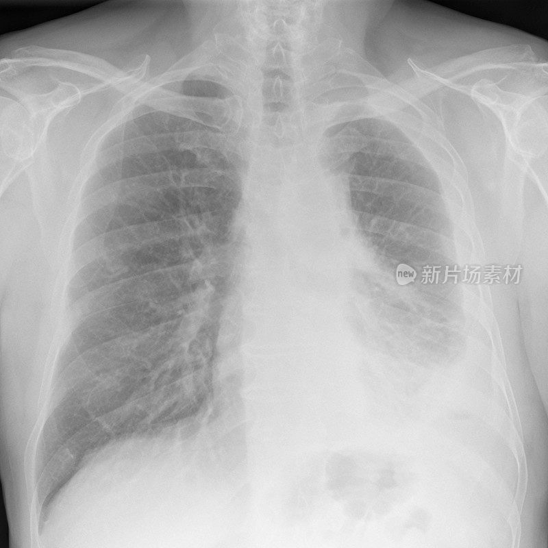 左侧胸部x线指片示晚期恶性间皮瘤