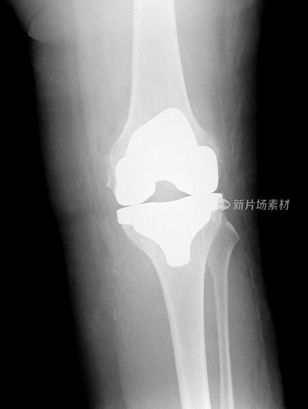 左侧全膝关节置换术后的数字x光片