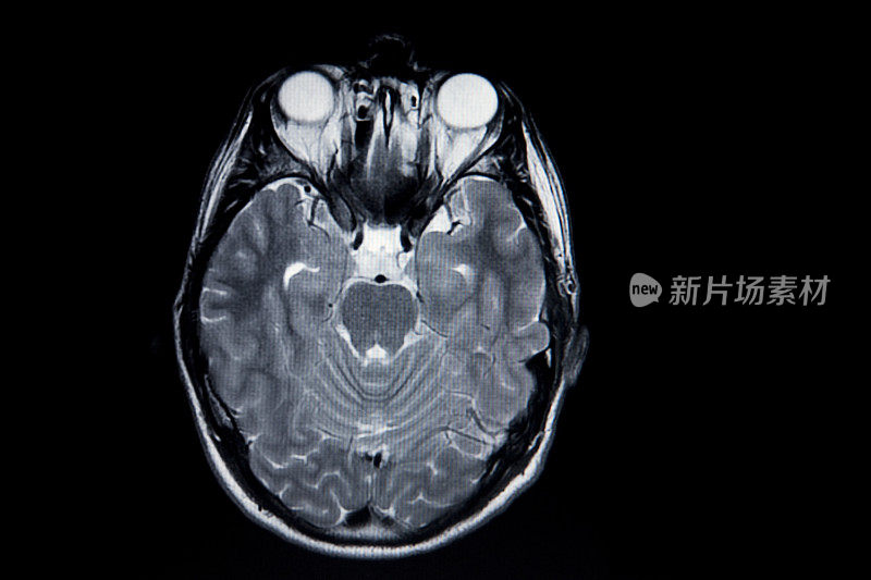 核磁共振大脑扫描