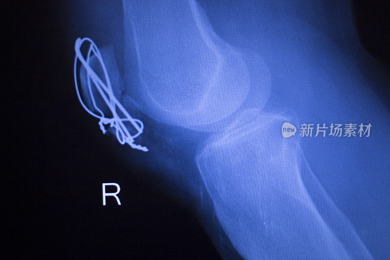 老年患者膝关节置换术骨科钛金属球窝植入物x线影像。