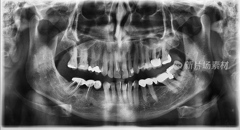 成人口腔全景x线影像显示多个根管及牙齿补片