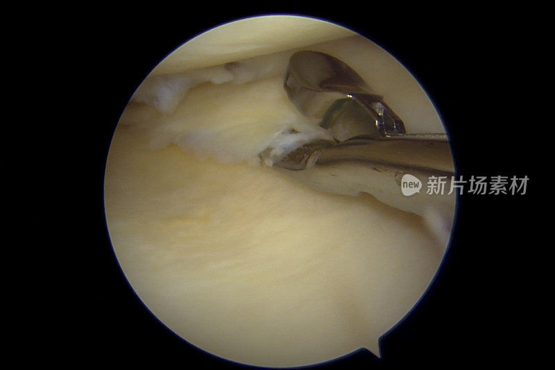 右膝内侧半月板后部皮瓣撕裂的关节镜观察