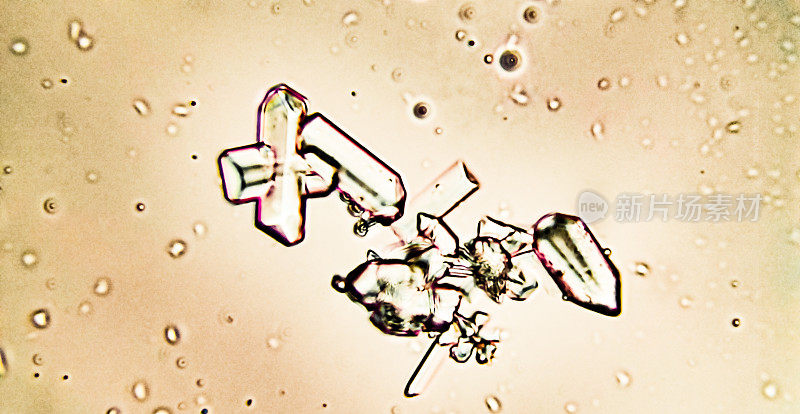显微镜下宠物尿液中的鸟粪石晶体