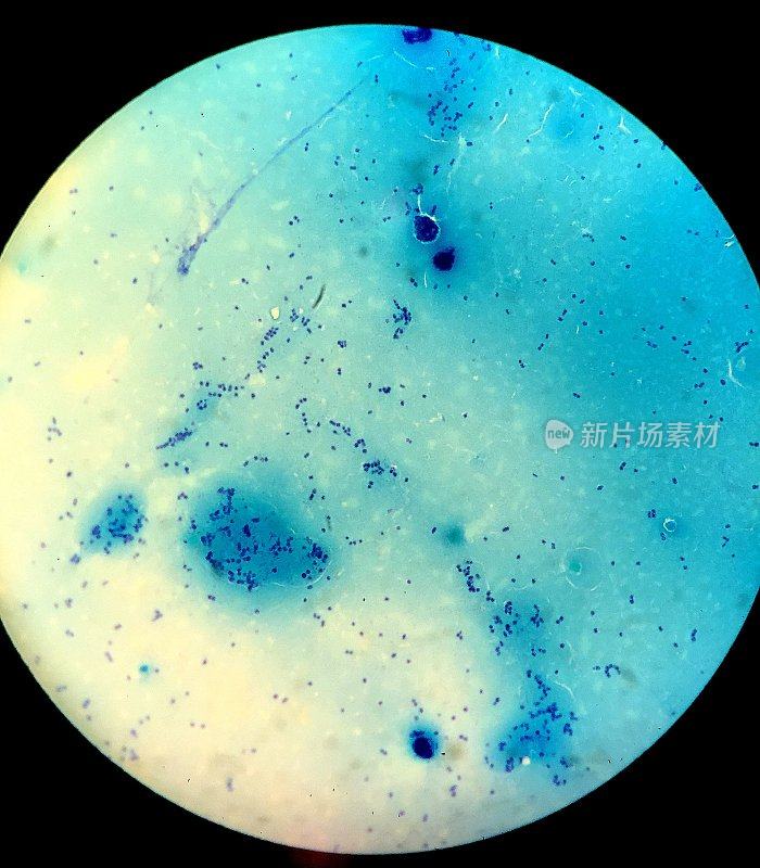 在显微镜下观察到带细菌的脑脊液