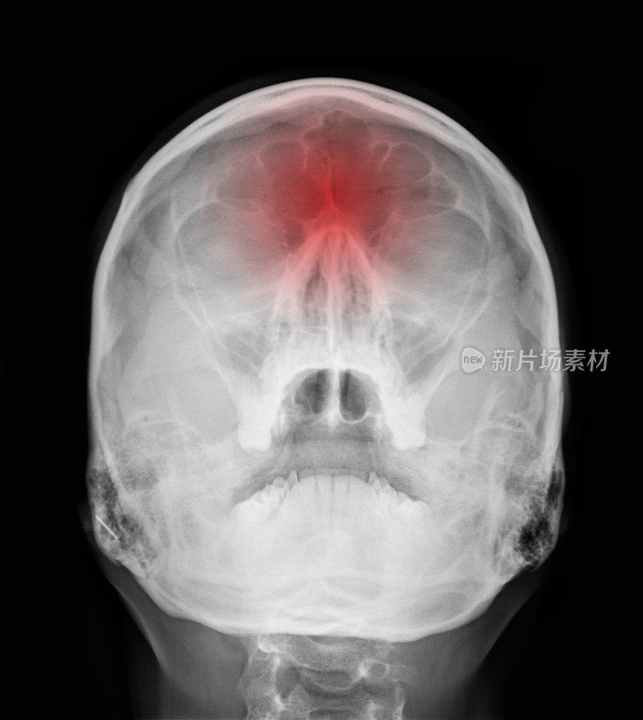 x线照片-鼻窦红色表示疼痛部位