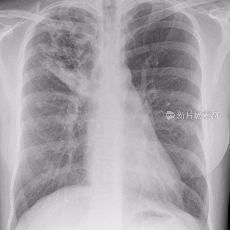一位年轻移民的x光胸片显示肺结核