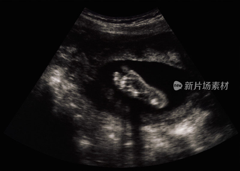 胎儿超声波-婴儿的脚