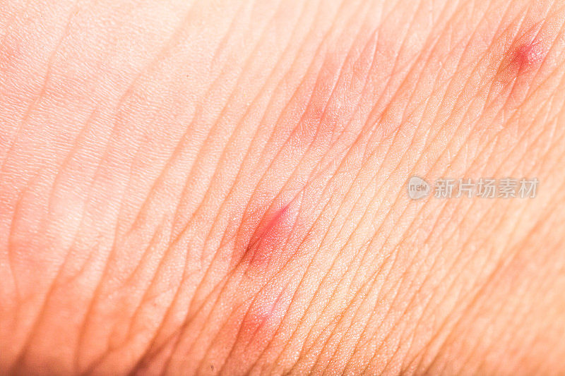 人皮肤被猫蚤咬出红疹